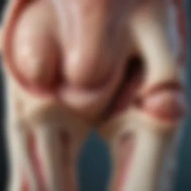Stages of Cartilage Degeneration A diagram depicting the stages of cartilage degeneration in advanced knee osteoarthritis
