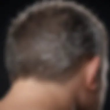 Understanding Dandruff: Scalp and Flake Formation Diagram showing the scalp and dandruff formation